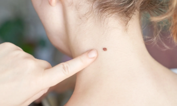 Memperkuat Sistem Imun untuk Melindungi Kulit dari Gangguan Lingkungan